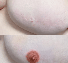 Reconstrucción areola