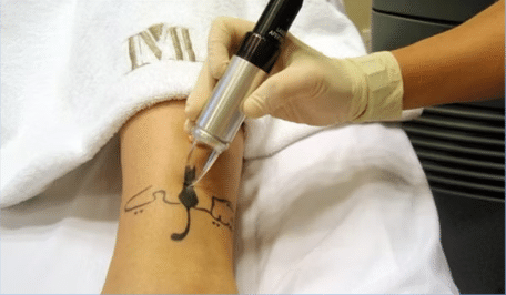 Eliminación de tatuaje